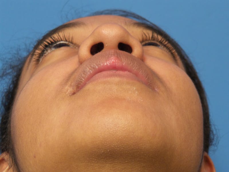 Rhinoplasty Before & After Gallery - Patient 124371 - Image 7