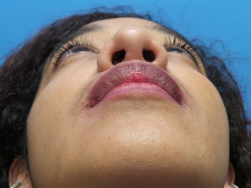 Rhinoplasty Before & After Gallery - Patient 124371 - Image 8