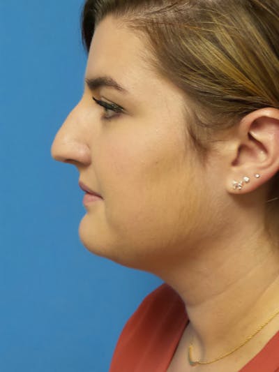 Rhinoplasty Before & After Gallery - Patient 123078 - Image 1