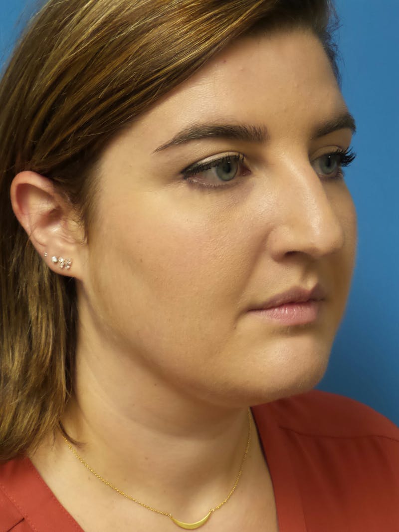 Rhinoplasty Before & After Gallery - Patient 123078 - Image 3