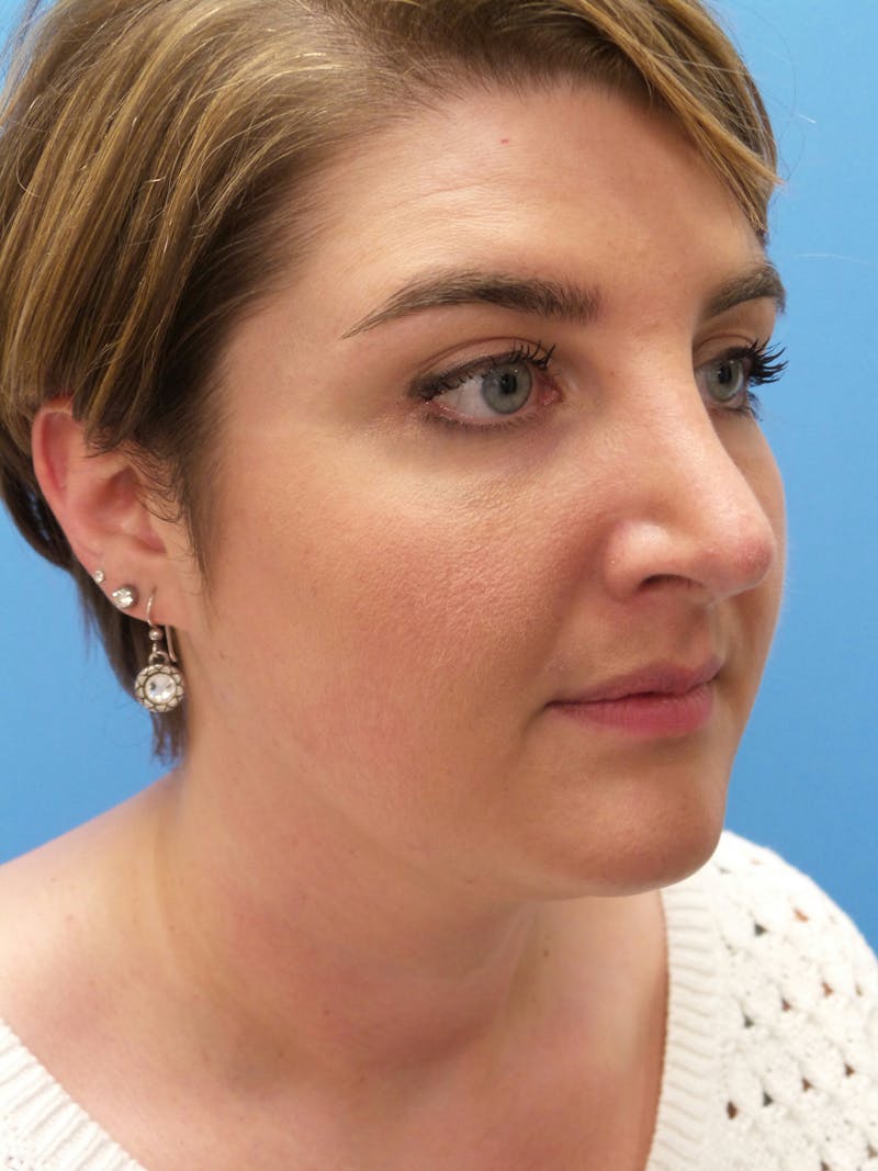 Rhinoplasty Before & After Gallery - Patient 123078 - Image 4