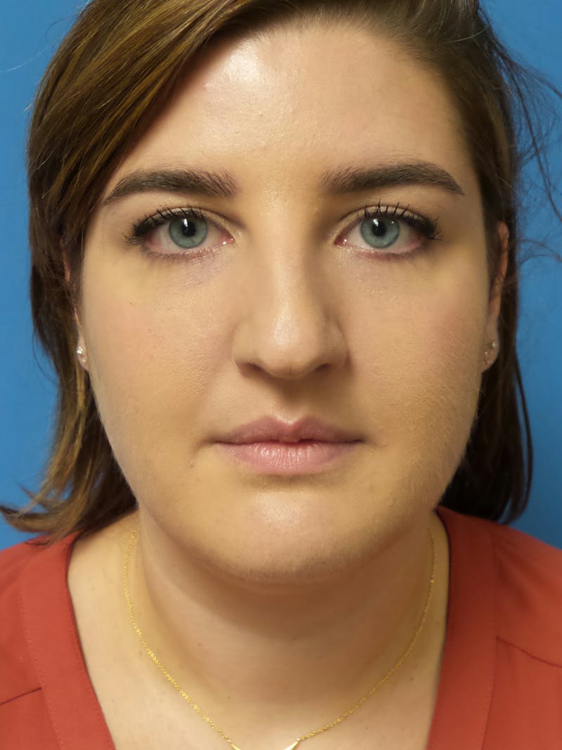 Rhinoplasty Before & After Gallery - Patient 123078 - Image 5