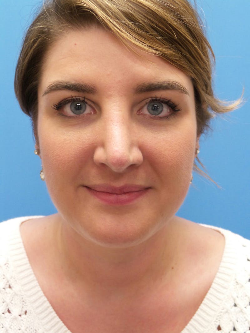 Rhinoplasty Before & After Gallery - Patient 123078 - Image 6
