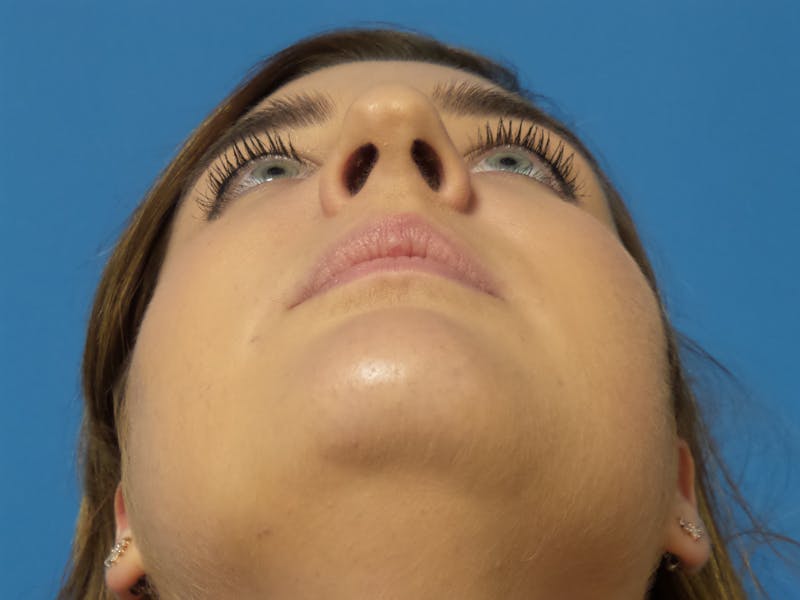 Rhinoplasty Before & After Gallery - Patient 123078 - Image 7