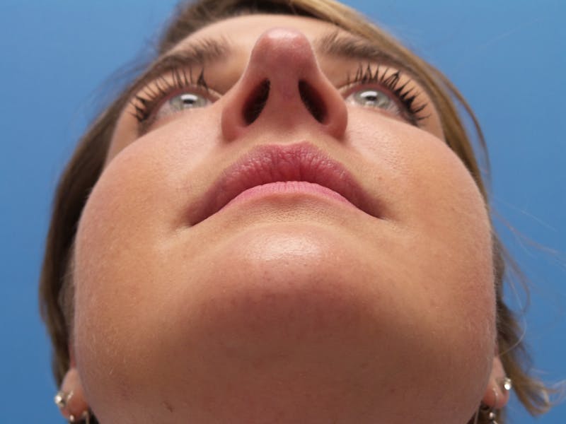 Rhinoplasty Before & After Gallery - Patient 123078 - Image 8