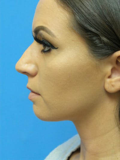 Rhinoplasty Before & After Gallery - Patient 331033 - Image 1