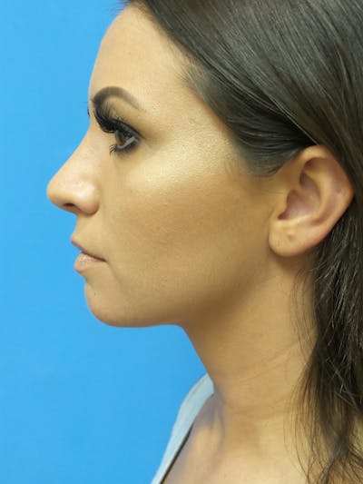 Rhinoplasty Before & After Gallery - Patient 331033 - Image 2