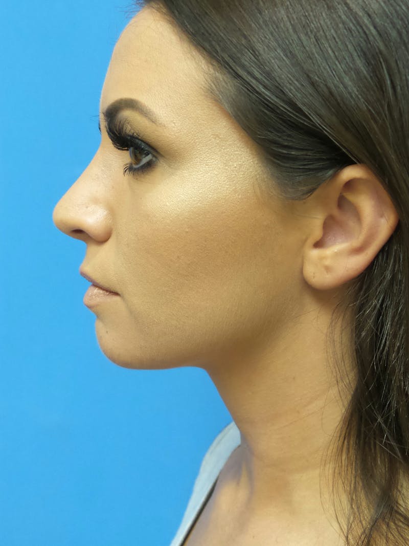 Rhinoplasty Before & After Gallery - Patient 331033 - Image 2