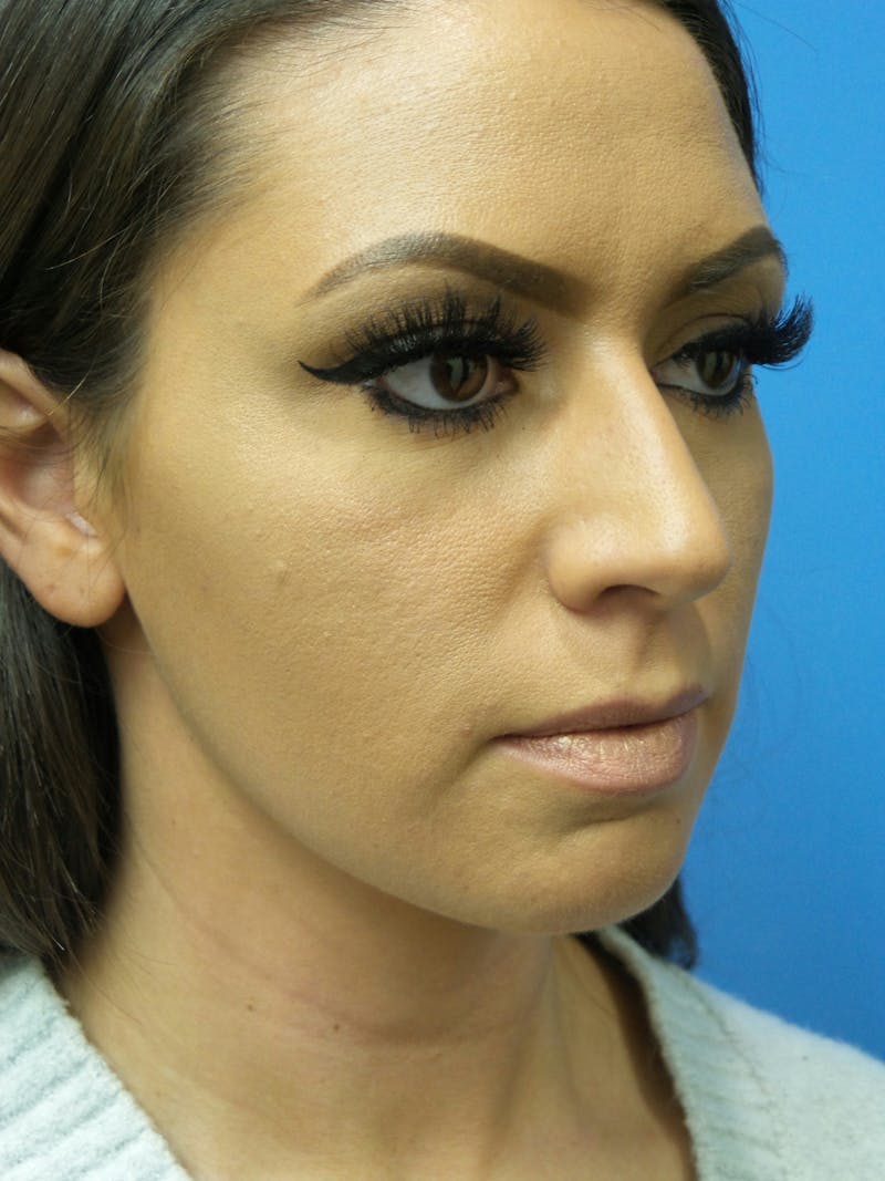 Rhinoplasty Before & After Gallery - Patient 331033 - Image 3