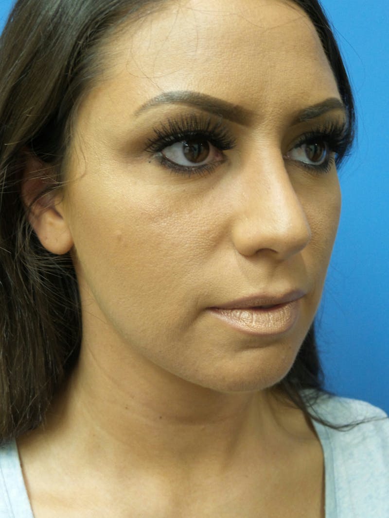 Rhinoplasty Before & After Gallery - Patient 331033 - Image 4