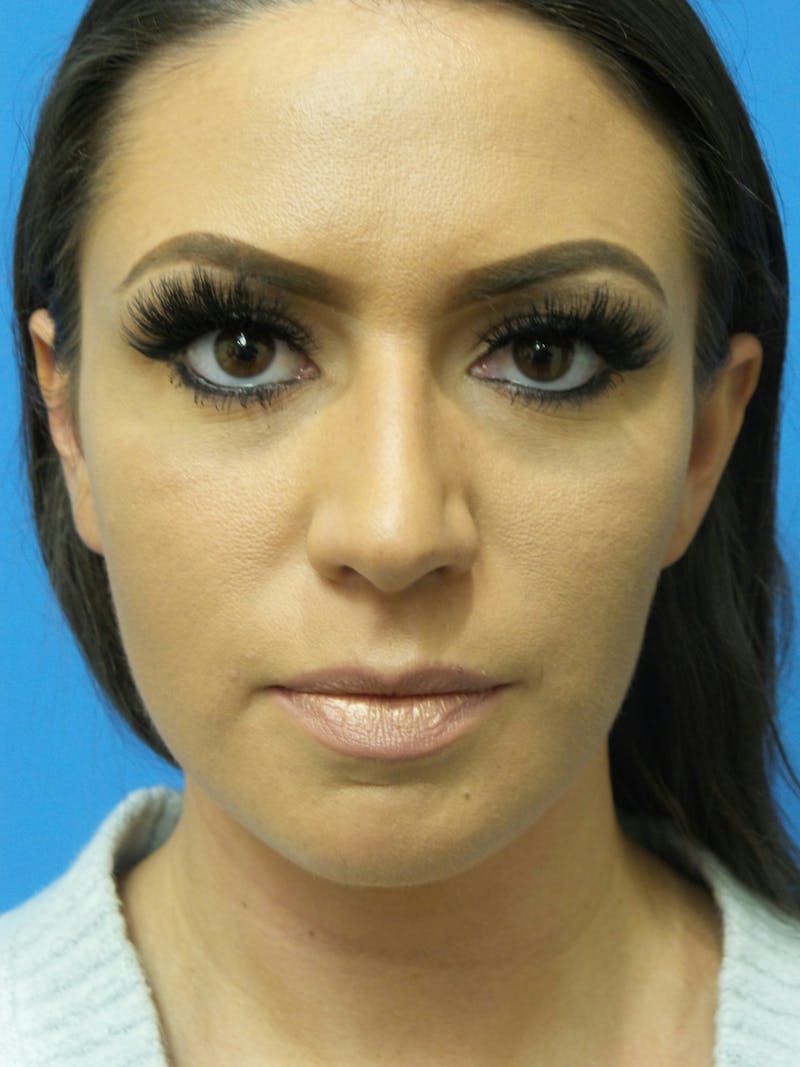 Rhinoplasty Before & After Gallery - Patient 331033 - Image 5