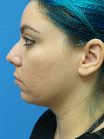Rhinoplasty Before & After Gallery - Patient 115070 - Image 1