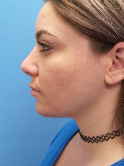 Rhinoplasty Before & After Gallery - Patient 115070 - Image 2