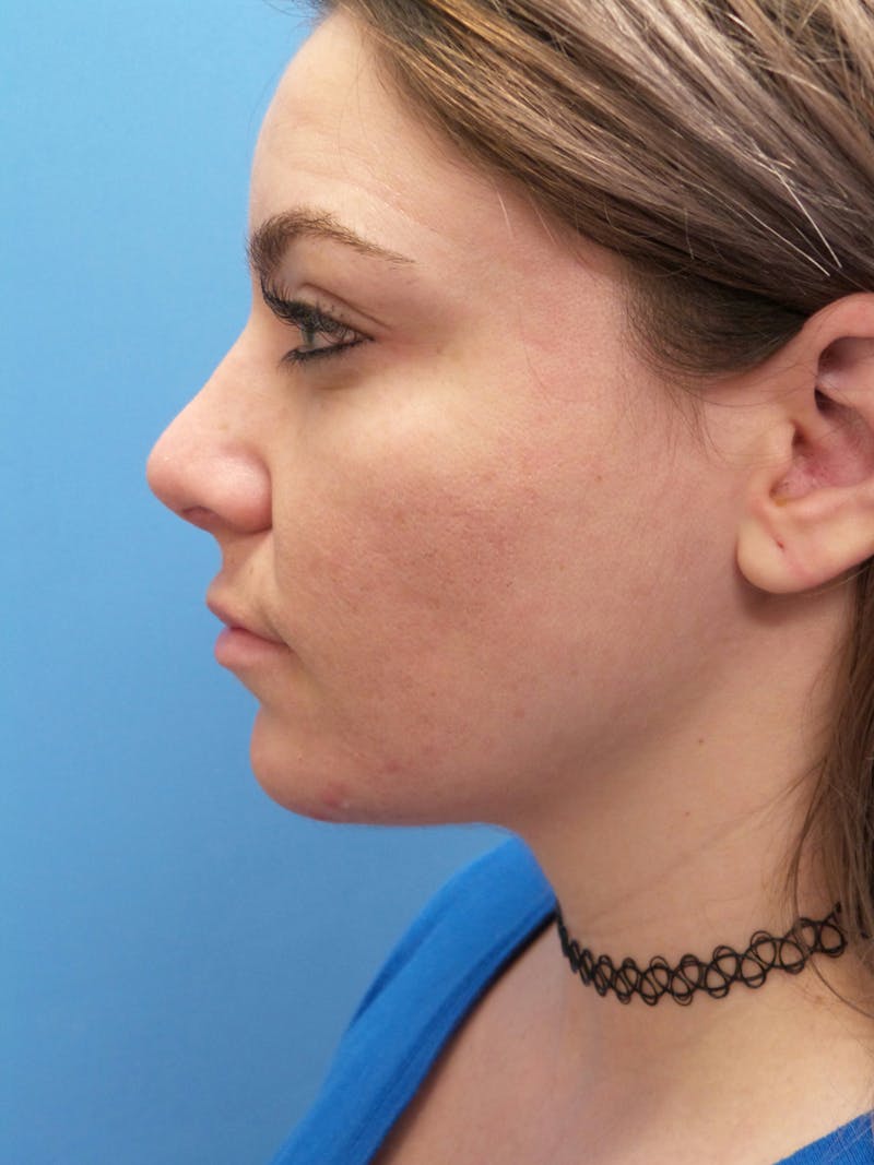 Rhinoplasty Before & After Gallery - Patient 115070 - Image 2