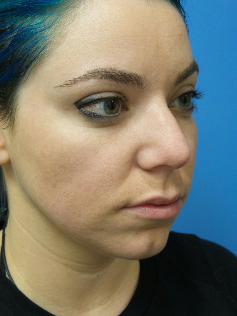 Rhinoplasty Before & After Gallery - Patient 115070 - Image 3