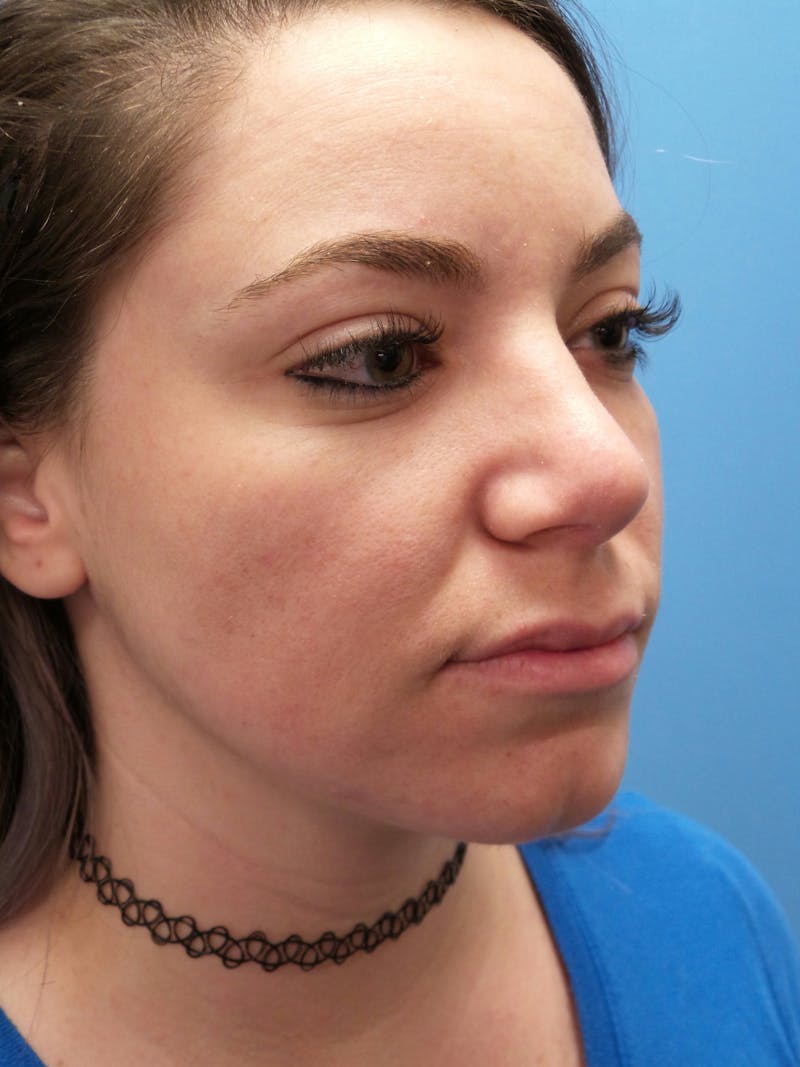 Rhinoplasty Before & After Gallery - Patient 115070 - Image 4