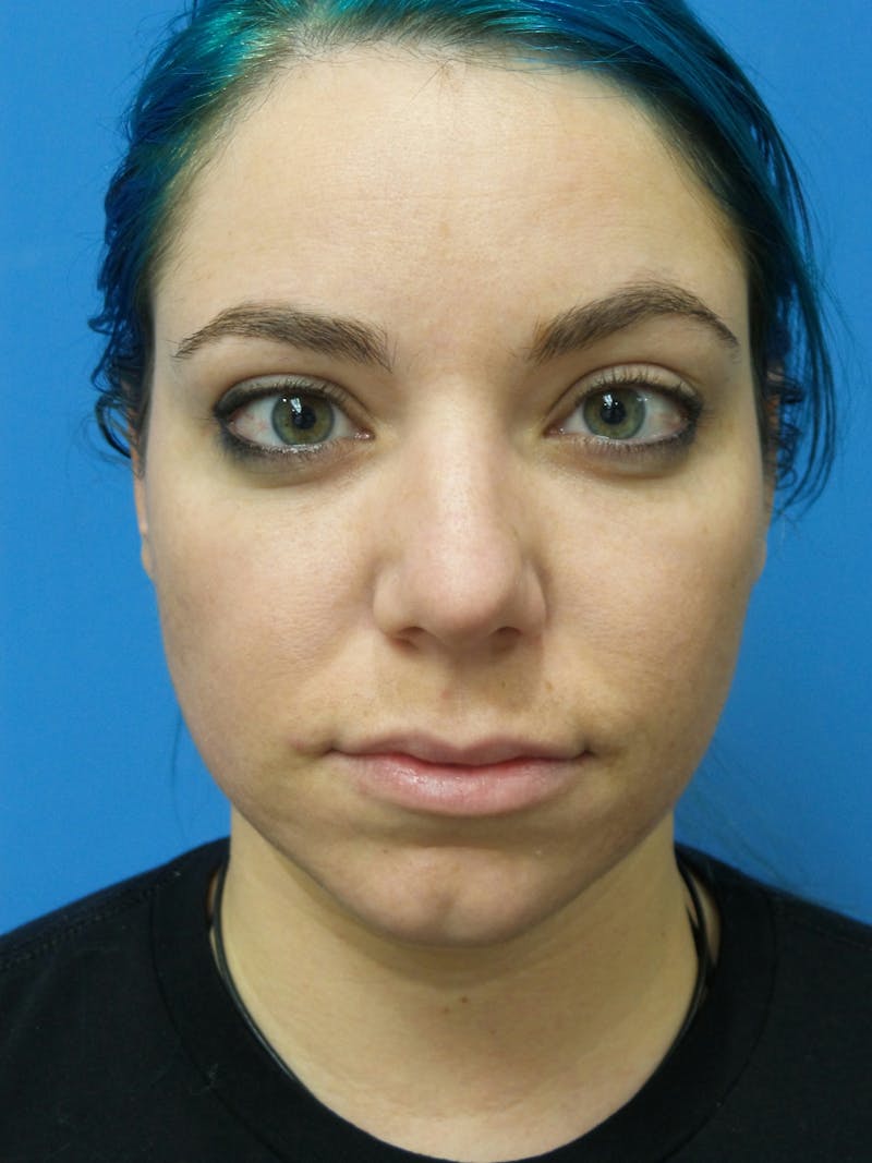 Rhinoplasty Before & After Gallery - Patient 115070 - Image 5