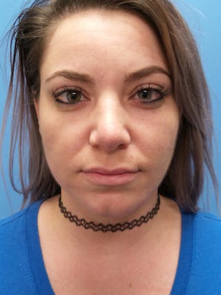 Rhinoplasty Before & After Gallery - Patient 115070 - Image 6