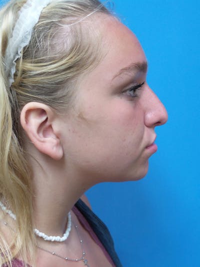 Rhinoplasty Before & After Gallery - Patient 413982 - Image 1