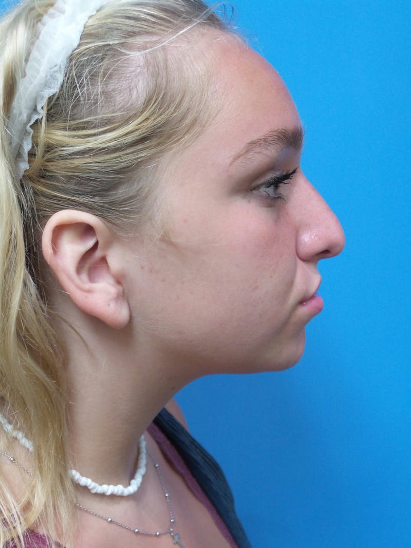 Rhinoplasty Before & After Gallery - Patient 413982 - Image 1