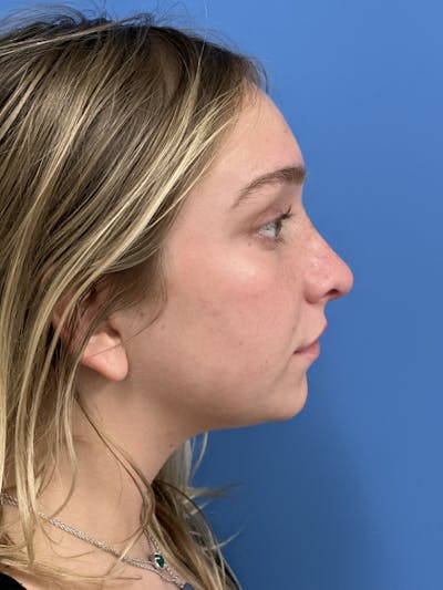 Rhinoplasty Before & After Gallery - Patient 413982 - Image 2