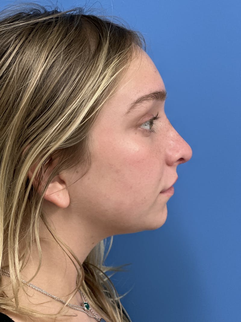 Rhinoplasty Before & After Gallery - Patient 413982 - Image 2