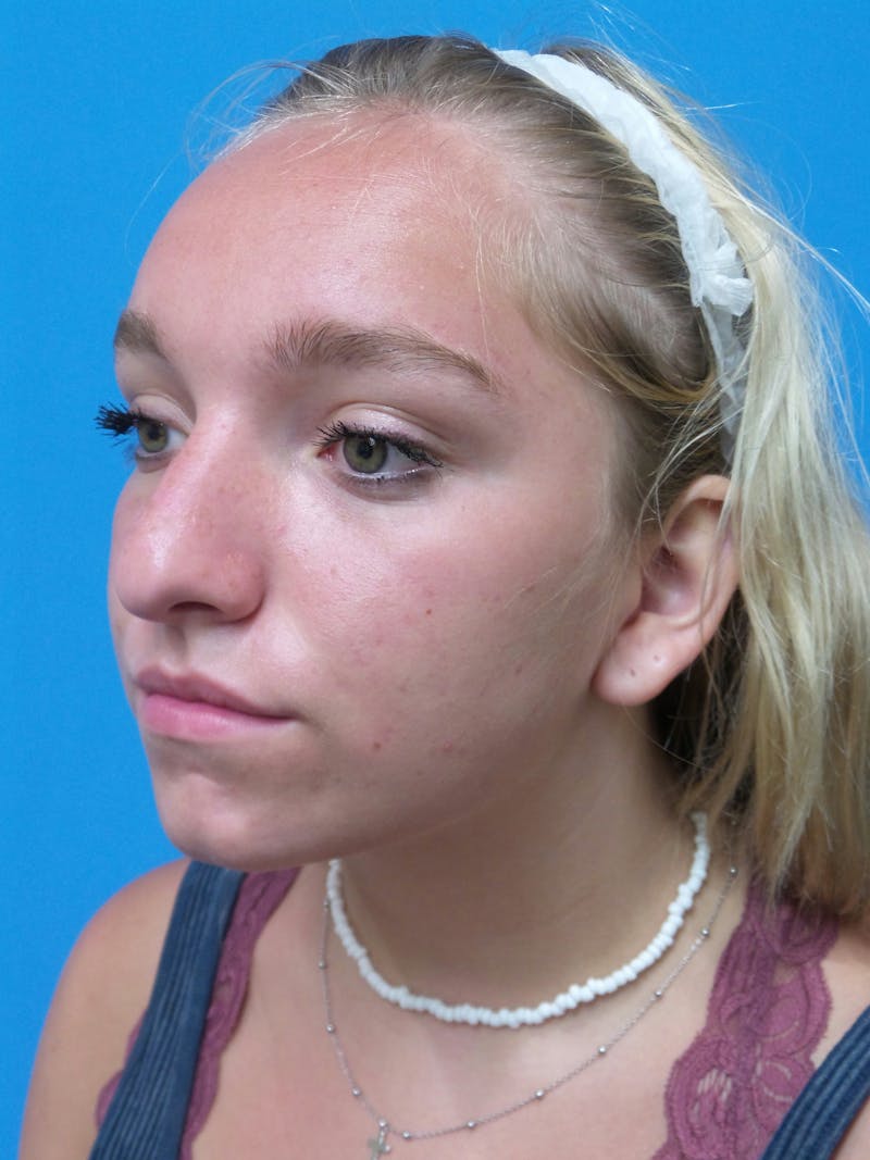 Rhinoplasty Before & After Gallery - Patient 413982 - Image 3
