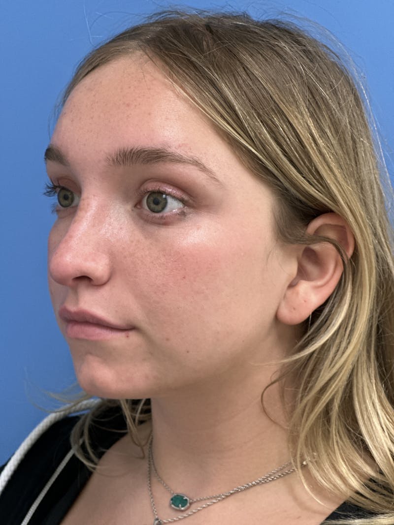 Rhinoplasty Before & After Gallery - Patient 413982 - Image 4