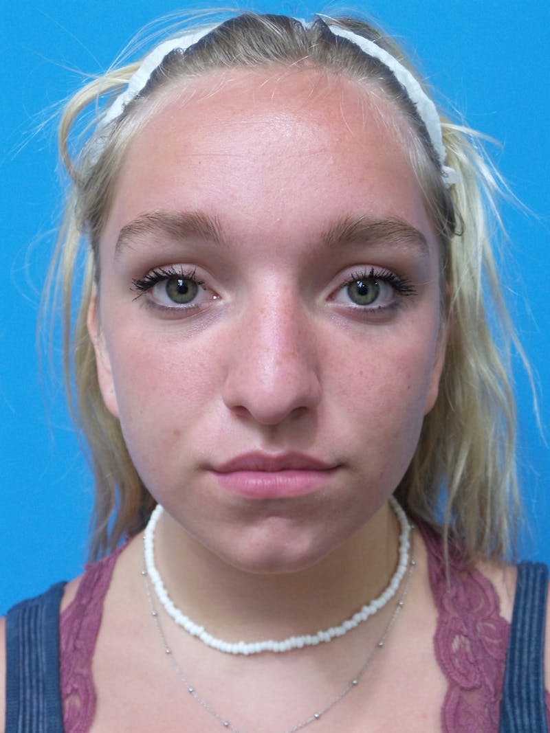 Rhinoplasty Before & After Gallery - Patient 413982 - Image 5