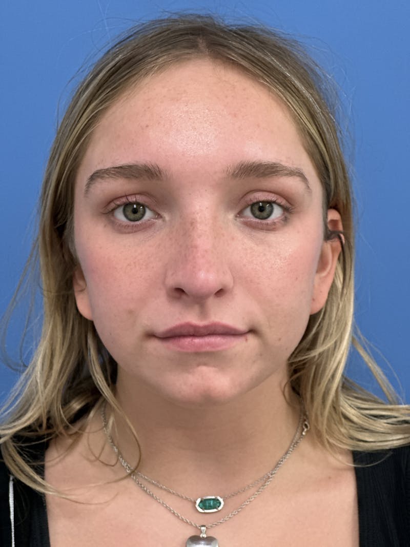 Rhinoplasty Before & After Gallery - Patient 413982 - Image 6