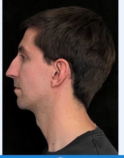 Rhinoplasty Before & After Gallery - Patient 797892 - Image 1