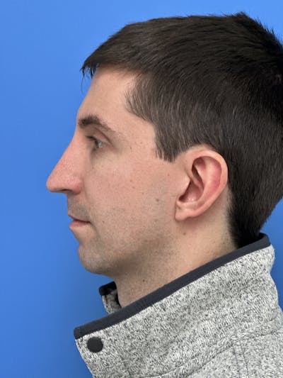 Rhinoplasty Before & After Gallery - Patient 797892 - Image 2