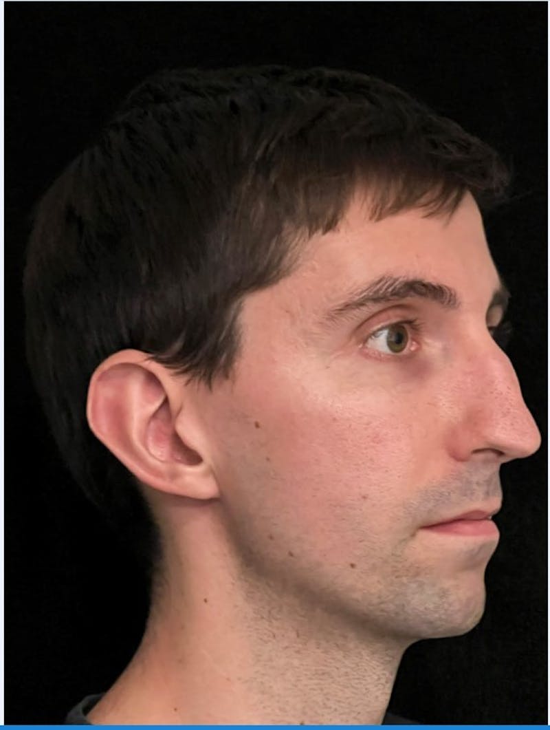 Rhinoplasty Before & After Gallery - Patient 797892 - Image 3