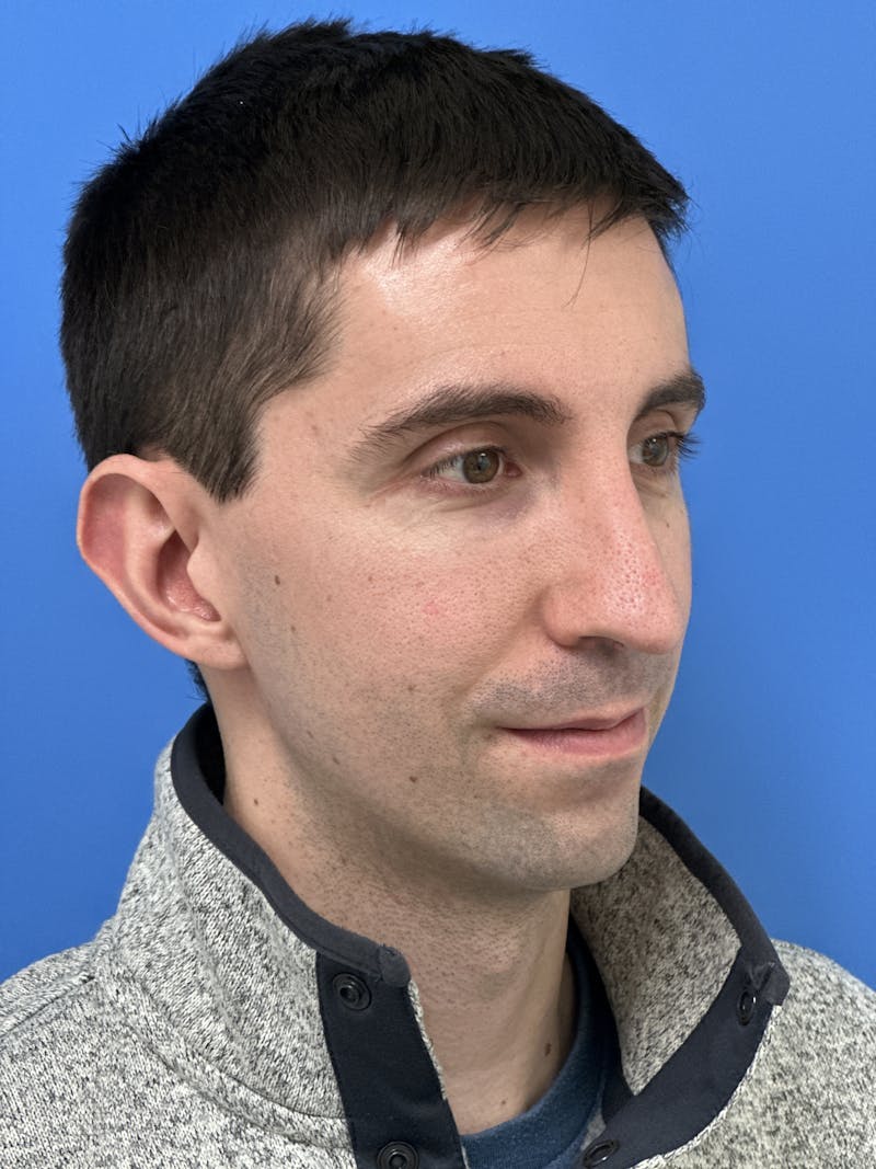 Rhinoplasty Before & After Gallery - Patient 797892 - Image 4