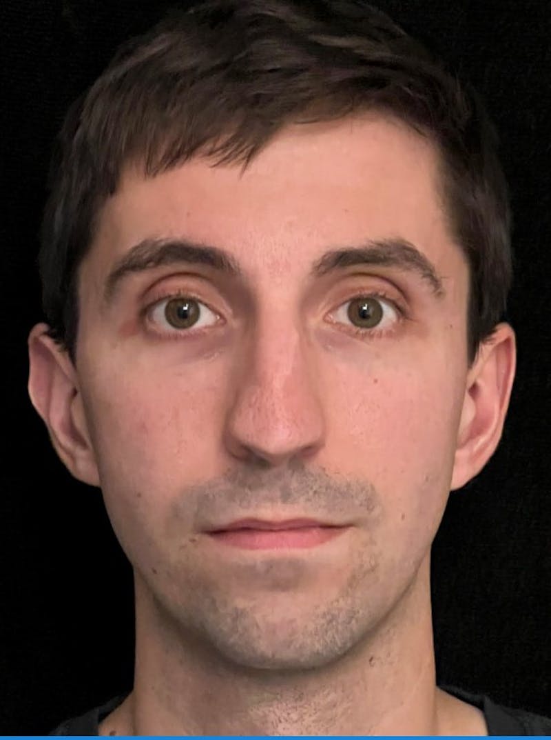 Rhinoplasty Before & After Gallery - Patient 797892 - Image 5
