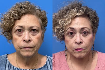 Brow Lift Before & After Gallery - Patient 599329 - Image 1