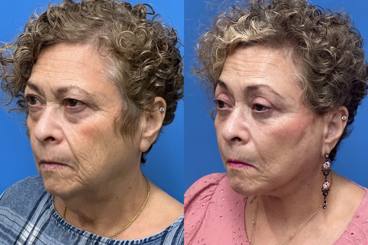 Brow Lift Before & After Gallery - Patient 599329 - Image 2