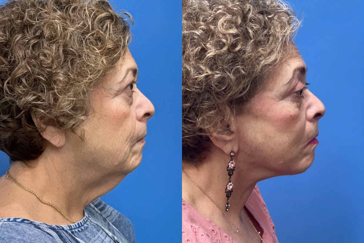 Brow Lift Before & After Gallery - Patient 599329 - Image 3