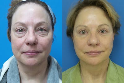 Facelift Before & After Gallery - Patient 302858 - Image 1