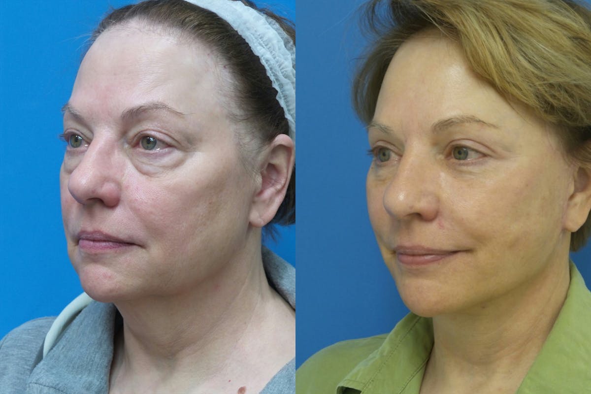 Facelift Before & After Gallery - Patient 302858 - Image 2