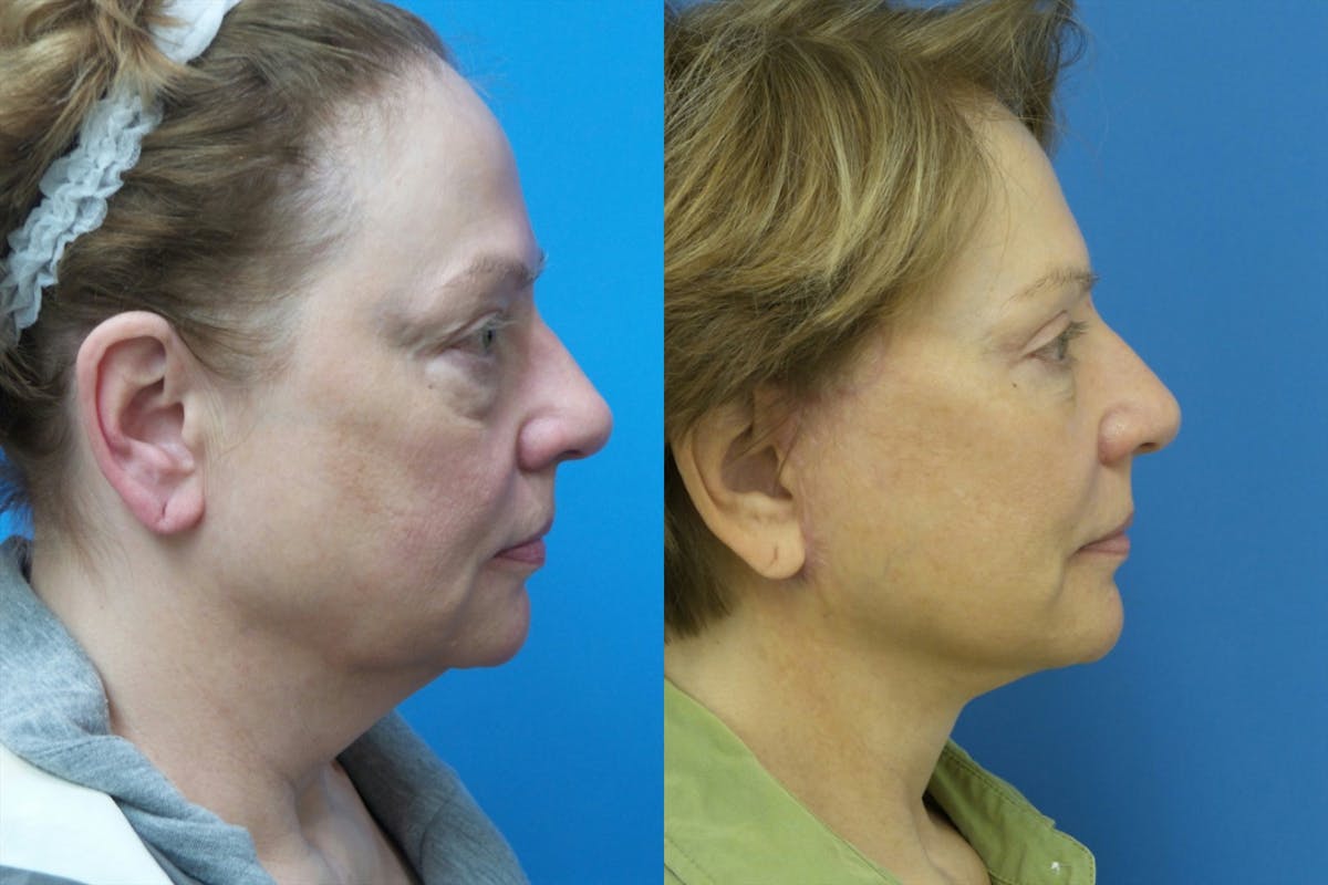 Facelift Before & After Gallery - Patient 302858 - Image 3