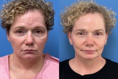 Brow Lift Before & After Gallery - Patient 278609 - Image 1