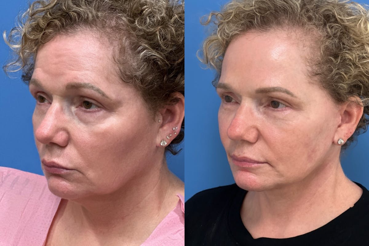 Brow Lift Before & After Gallery - Patient 278609 - Image 2