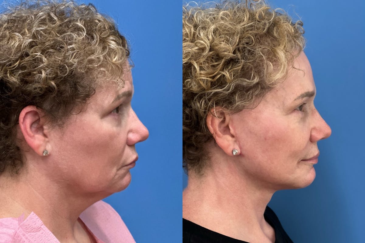 Brow Lift Before & After Gallery - Patient 278609 - Image 3