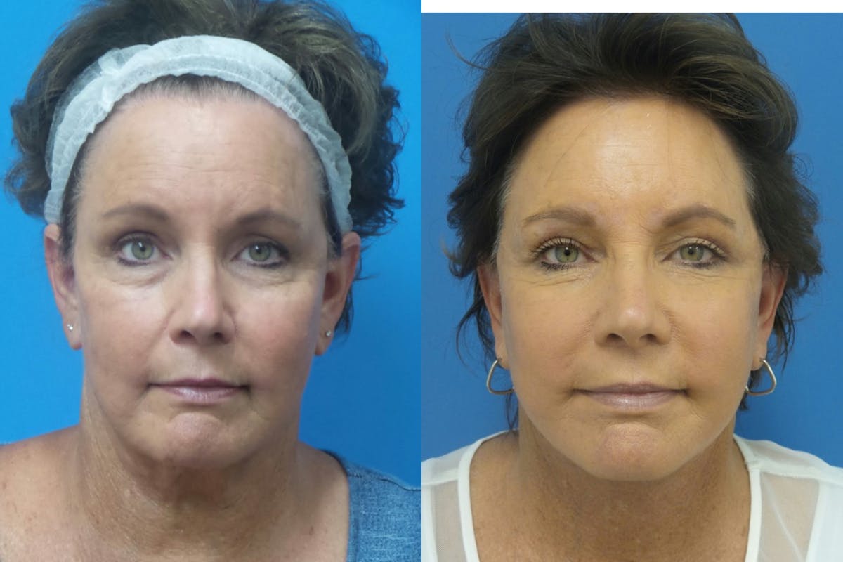 Facelift Before & After Gallery - Patient 411687 - Image 1