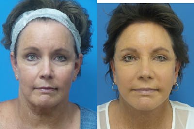 Facelift Before & After Gallery - Patient 411687 - Image 1