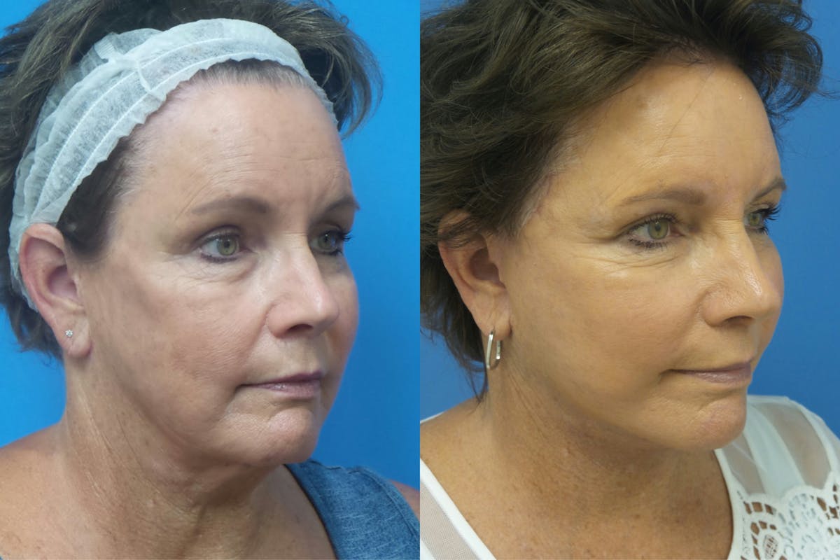 Facelift Before & After Gallery - Patient 411687 - Image 2