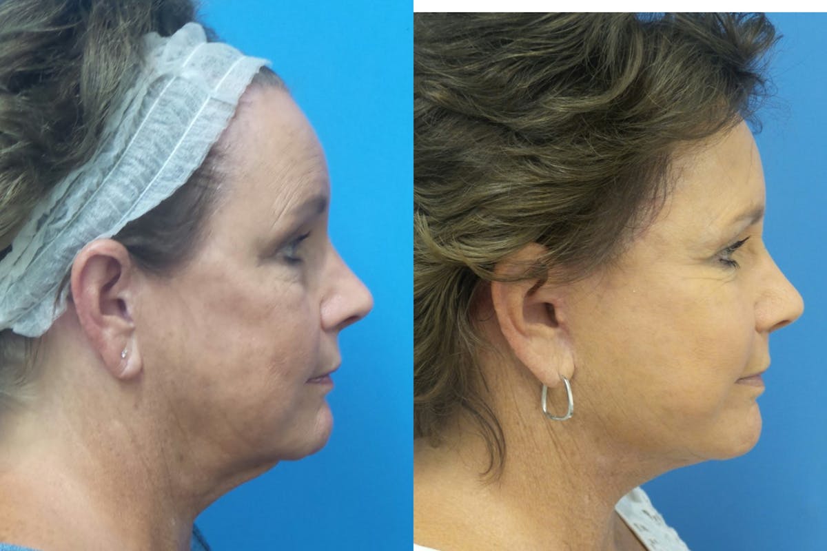 Facelift Before & After Gallery - Patient 411687 - Image 3
