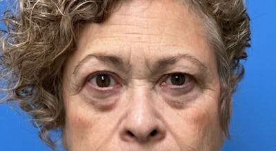 Eyelid Surgery Before & After Gallery - Patient 116275 - Image 1