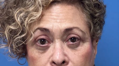 Eyelid Surgery Before & After Gallery - Patient 116275 - Image 2